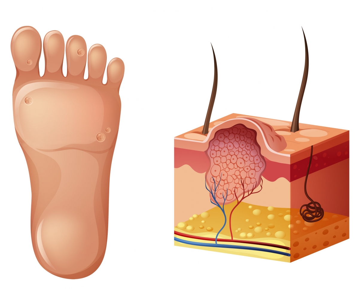 verruga plantar